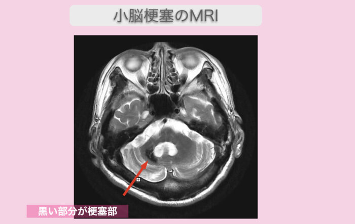 小脳梗塞のMRI