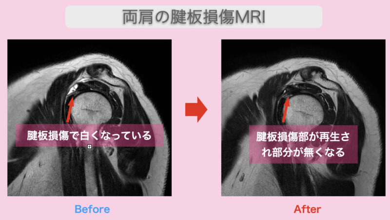 両肩の腱板損傷MRI 2023-08-24 11.22.17