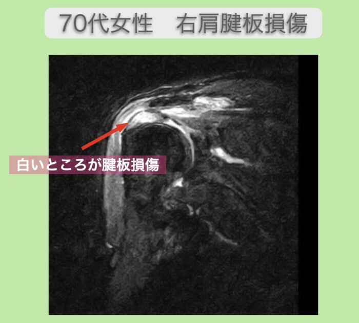 肩腱板損傷