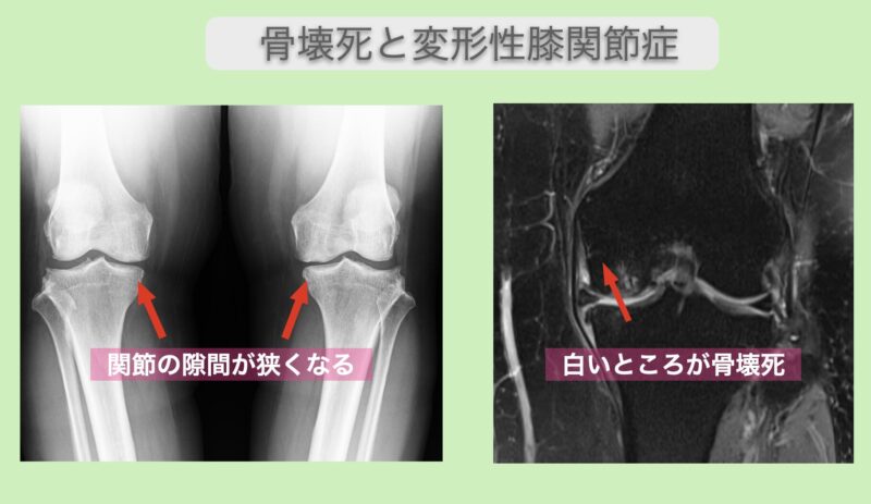 骨壊死と変形性膝関節症