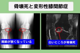 骨壊死と変形性膝関節症に幹細胞治療