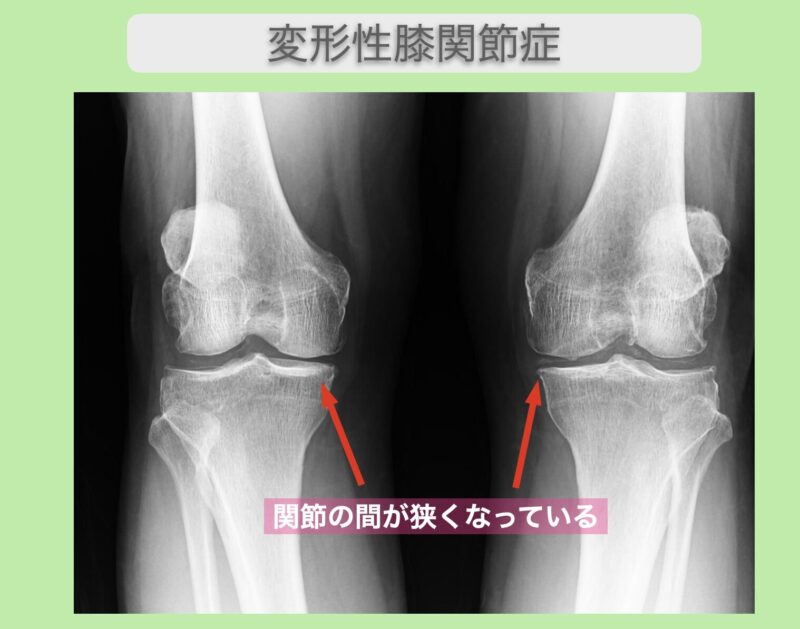 両変形性膝関節症