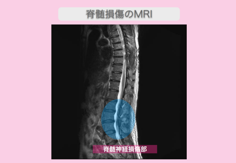 頚髄症性脊髄症　幹細胞治療　80代男性