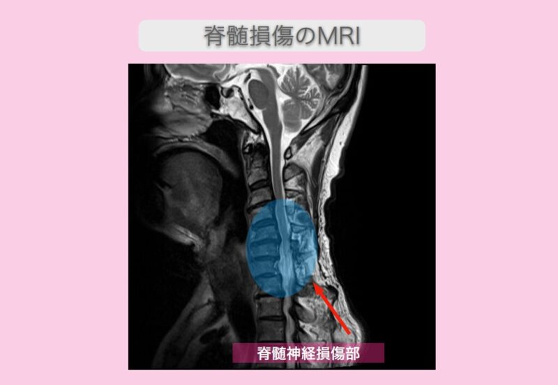 頚髄症性脊髄症　幹細胞治療　70代男性