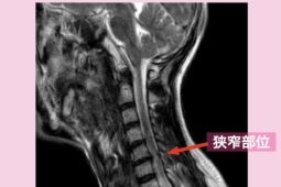 頚髄損傷　幹細胞治療 50代男性