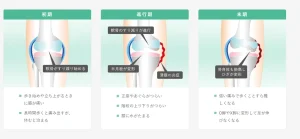 変形性膝関節症の図解