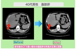 脂肪肝の幹細胞治療でCTが改善！γ―ＧＴＰも半減に！　40代男性