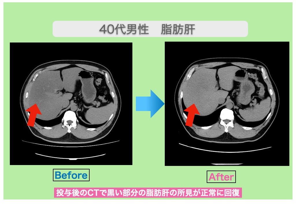 脂肪肝の幹細胞治療でCTが改善！γ―ＧＴＰも半減に！　40代男性