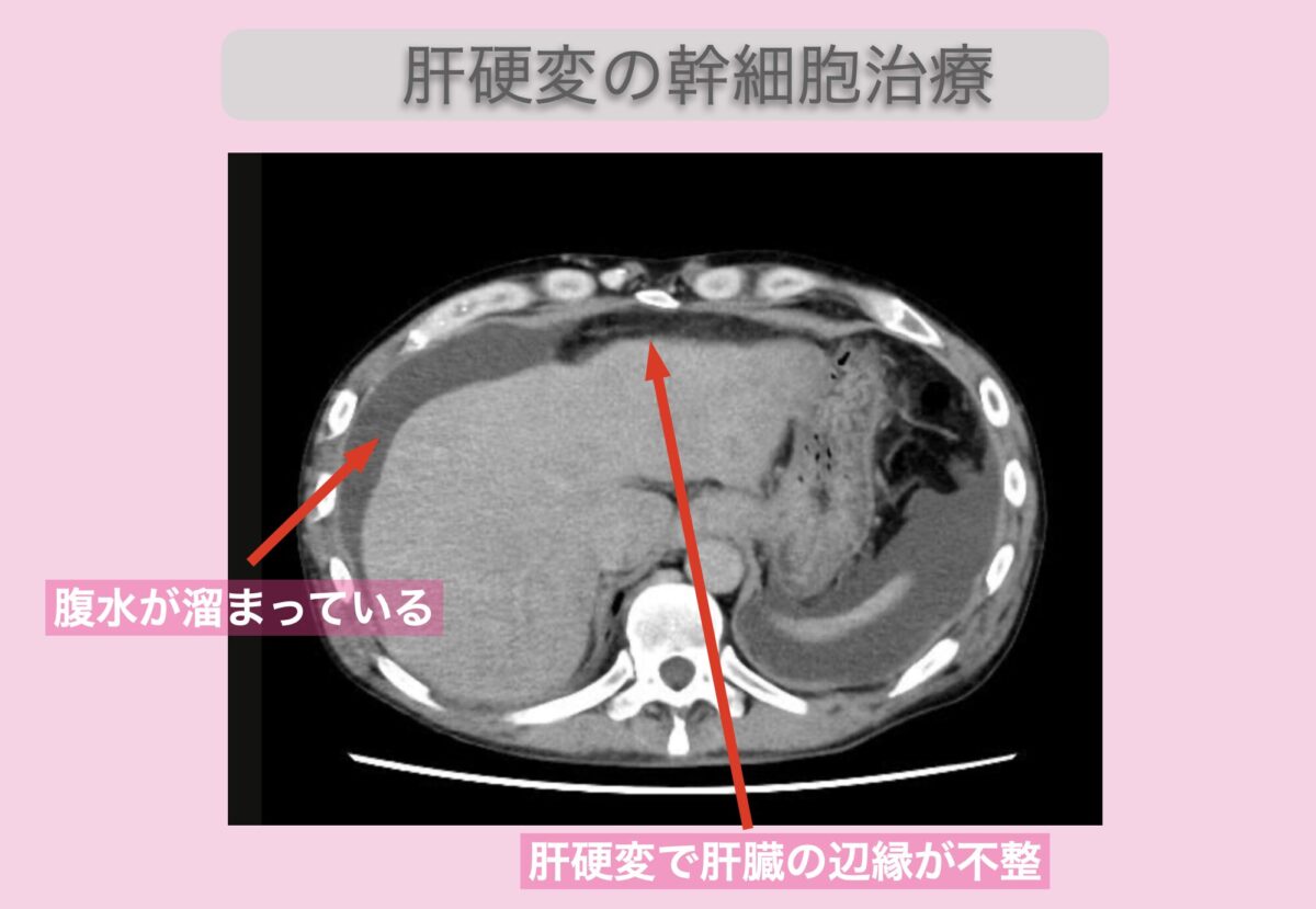 肝硬変　50代男性