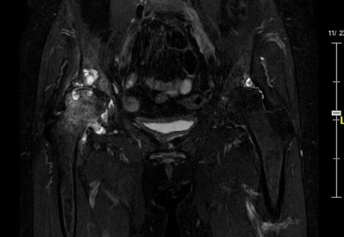 股関節症　MRI