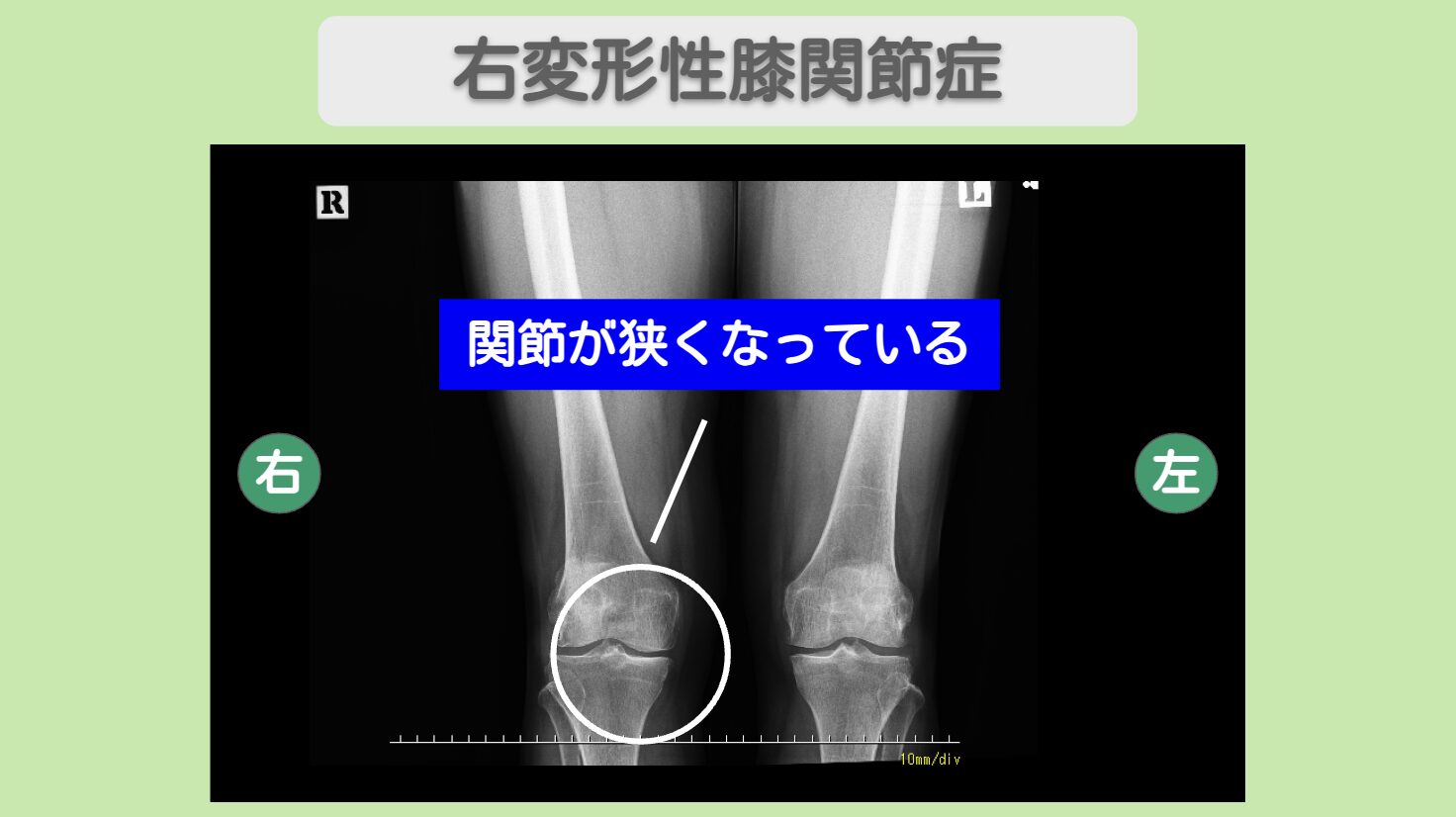 右変形性膝関節症