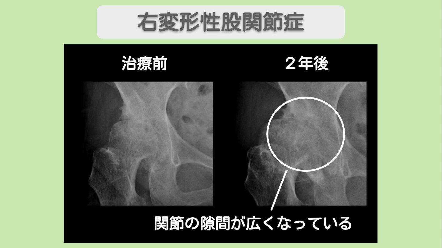 右変形性股関節症 幹細胞治療