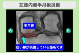 半月板損傷