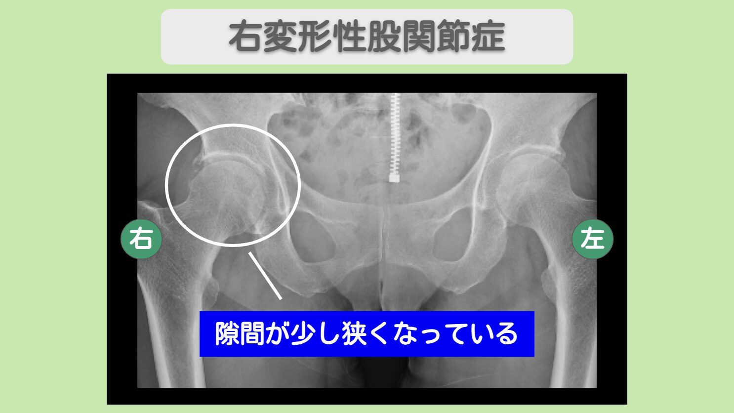 右変形性股関節症 幹細胞治療