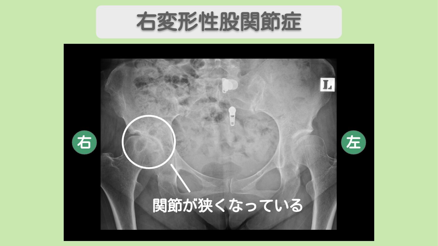 右変形性股関節症（臼蓋形成不全） 幹細胞治療 