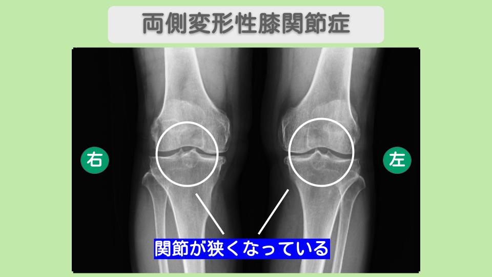 両膝変形性関節症  幹細胞治療 70代女性