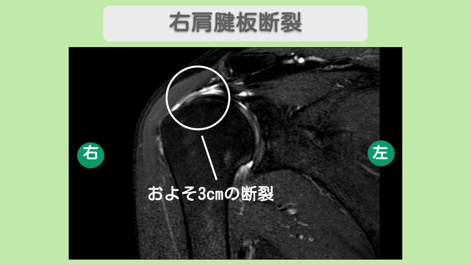 右肩腱板断裂 幹細胞治療 70代女性