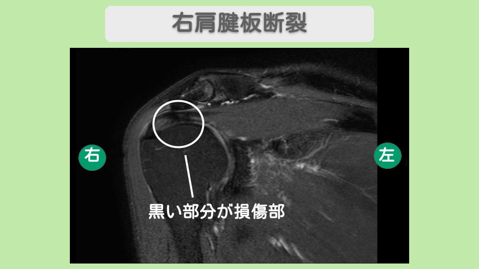 両肩腱板損傷 幹細胞治療 60代女性