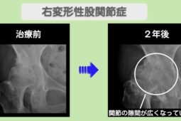 変形性股関節症　ビフォーアフター