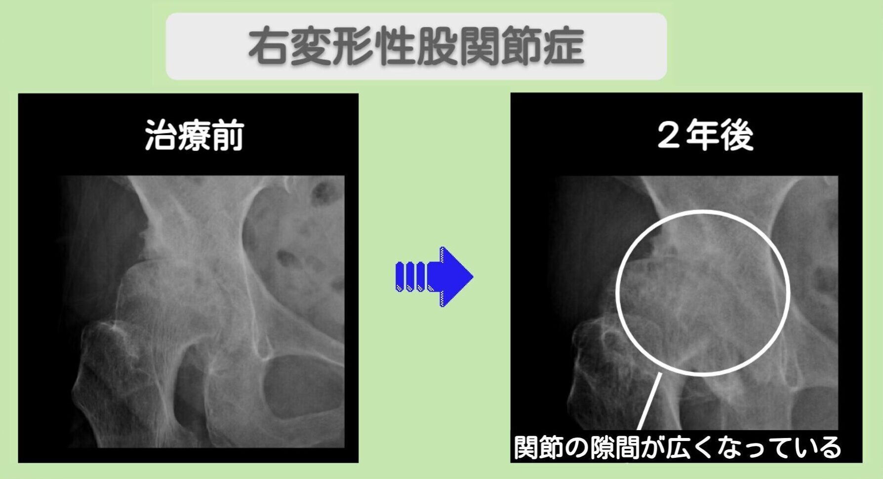 変形性股関節症 ビフォーアフター