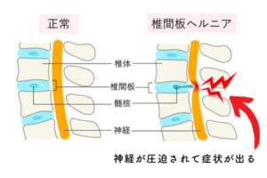 肩が痛い！医師が詳しく解説