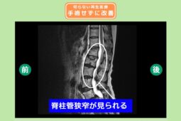 腰部脊柱管狭窄症　手術せずに痛みが消失