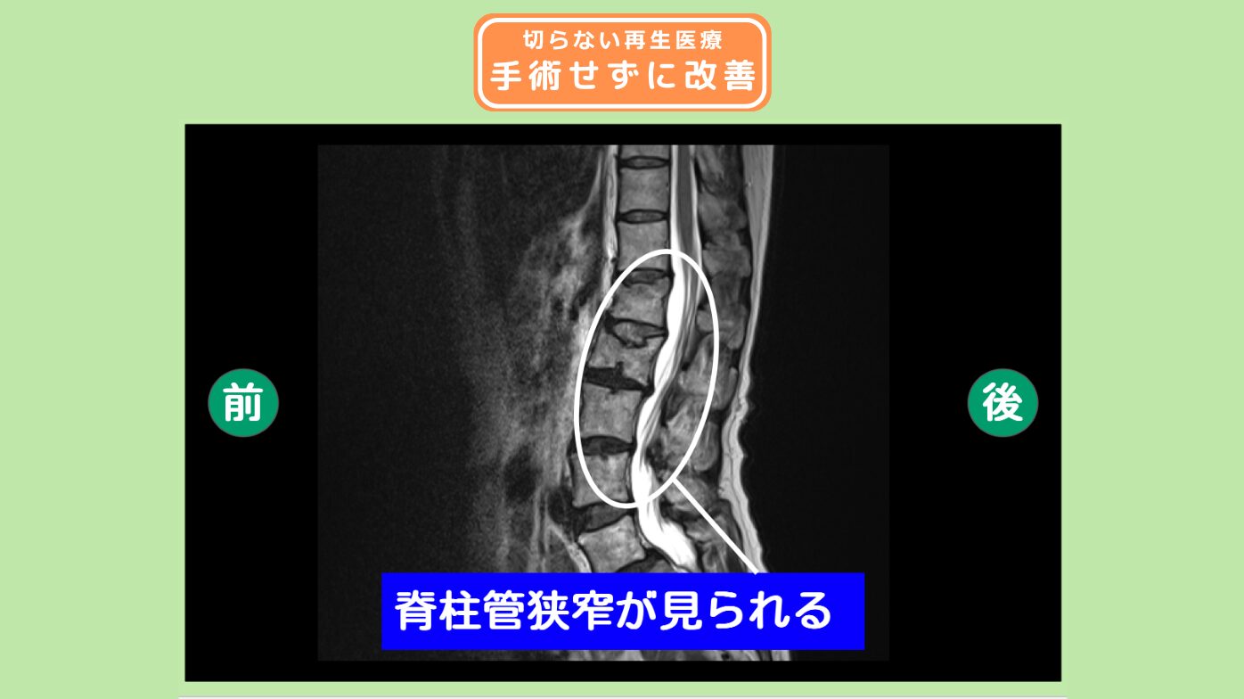 腰部脊柱管狭窄症 手術せずに痛みが消失