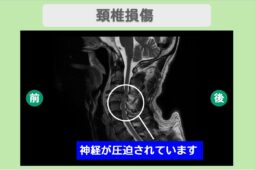 頚髄損傷 幹細胞治療