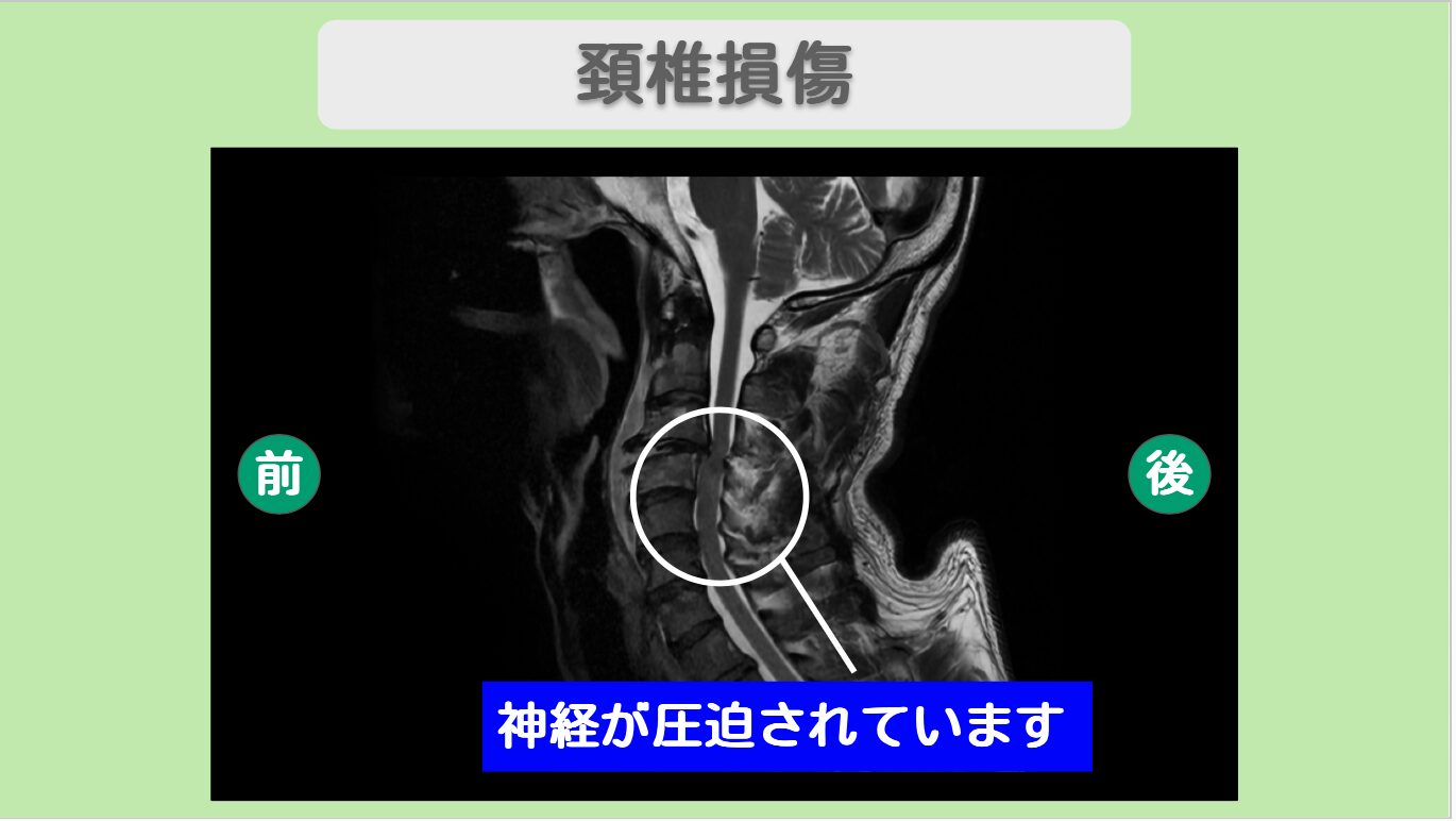 頚髄損傷 幹細胞治療