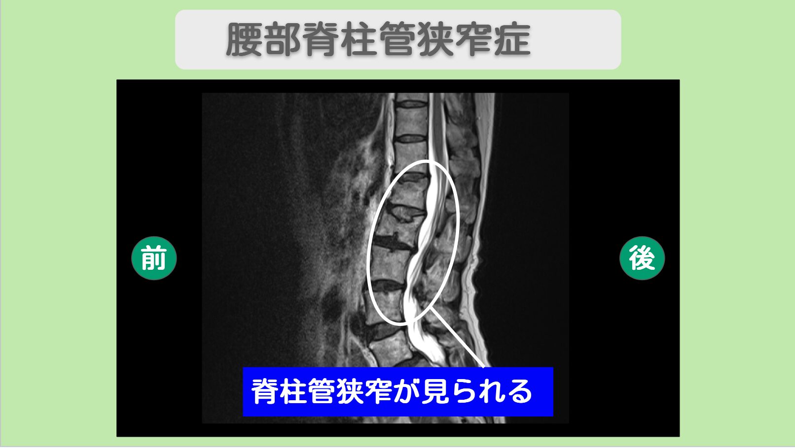 腰椎椎間板ヘルニア 幹細胞治療