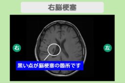 急性期脳梗塞 幹細胞治療