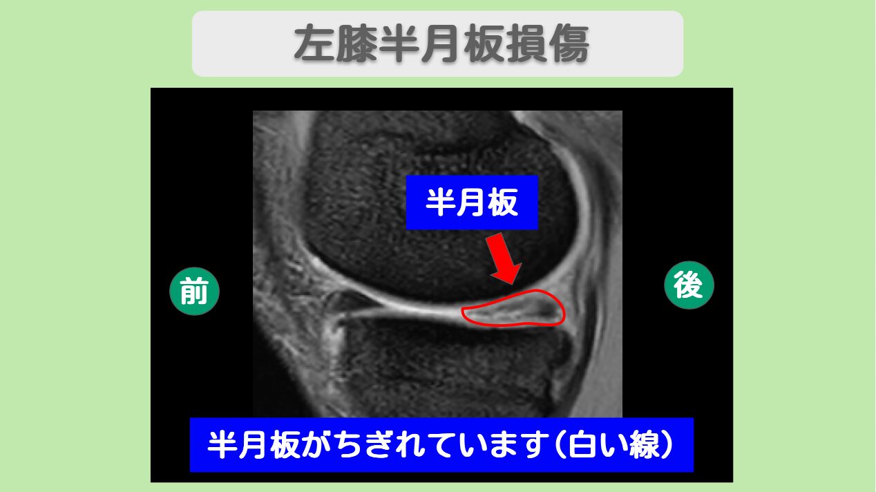 半月板損傷