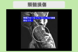 頚椎症性脊髄症 幹細胞治療