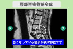 脊椎疾患への新たな光明：手術前に考えたい幹細胞治療の可能性