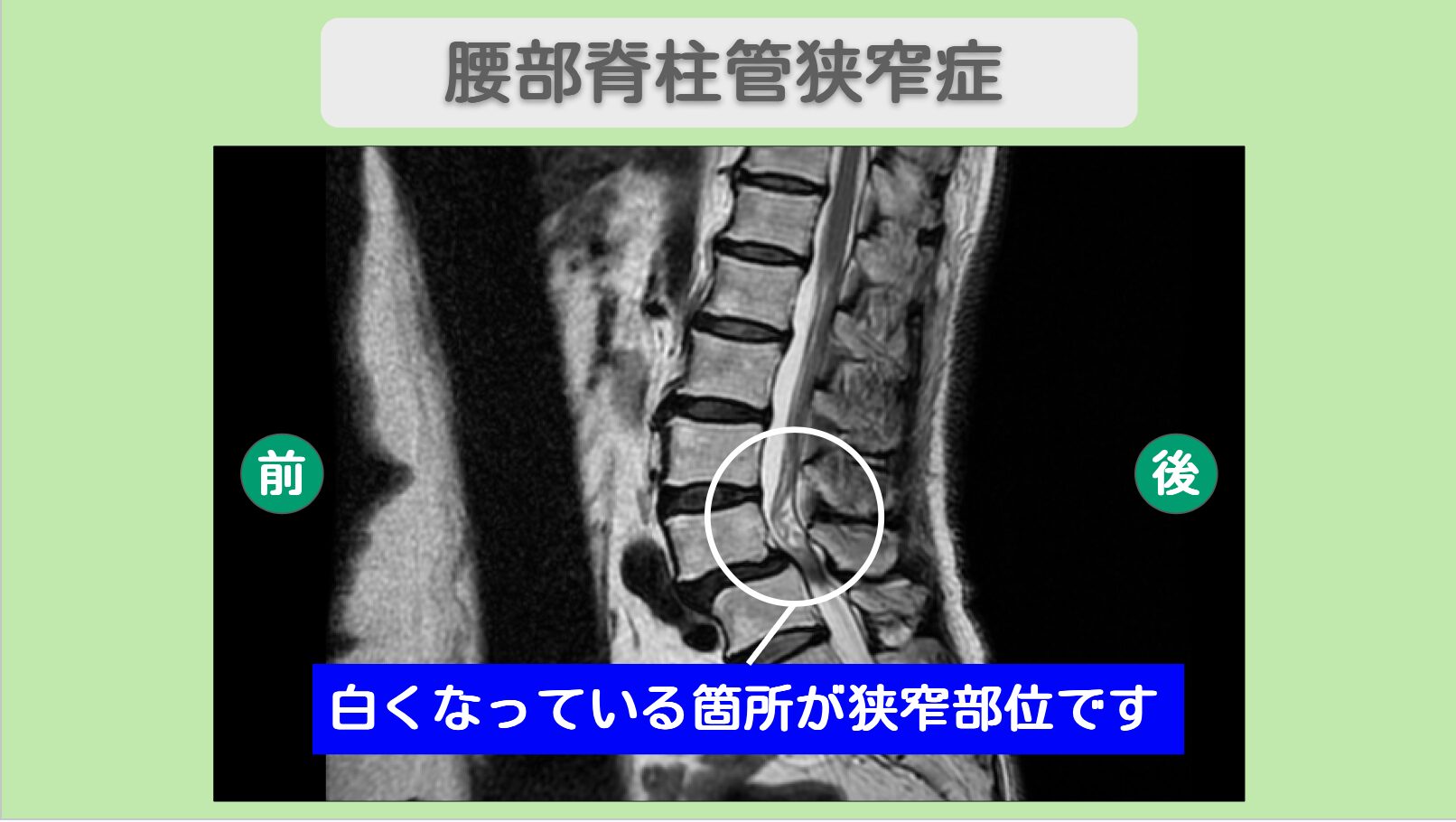 脊椎疾患への新たな光明：手術前に考えたい幹細胞治療の可能性