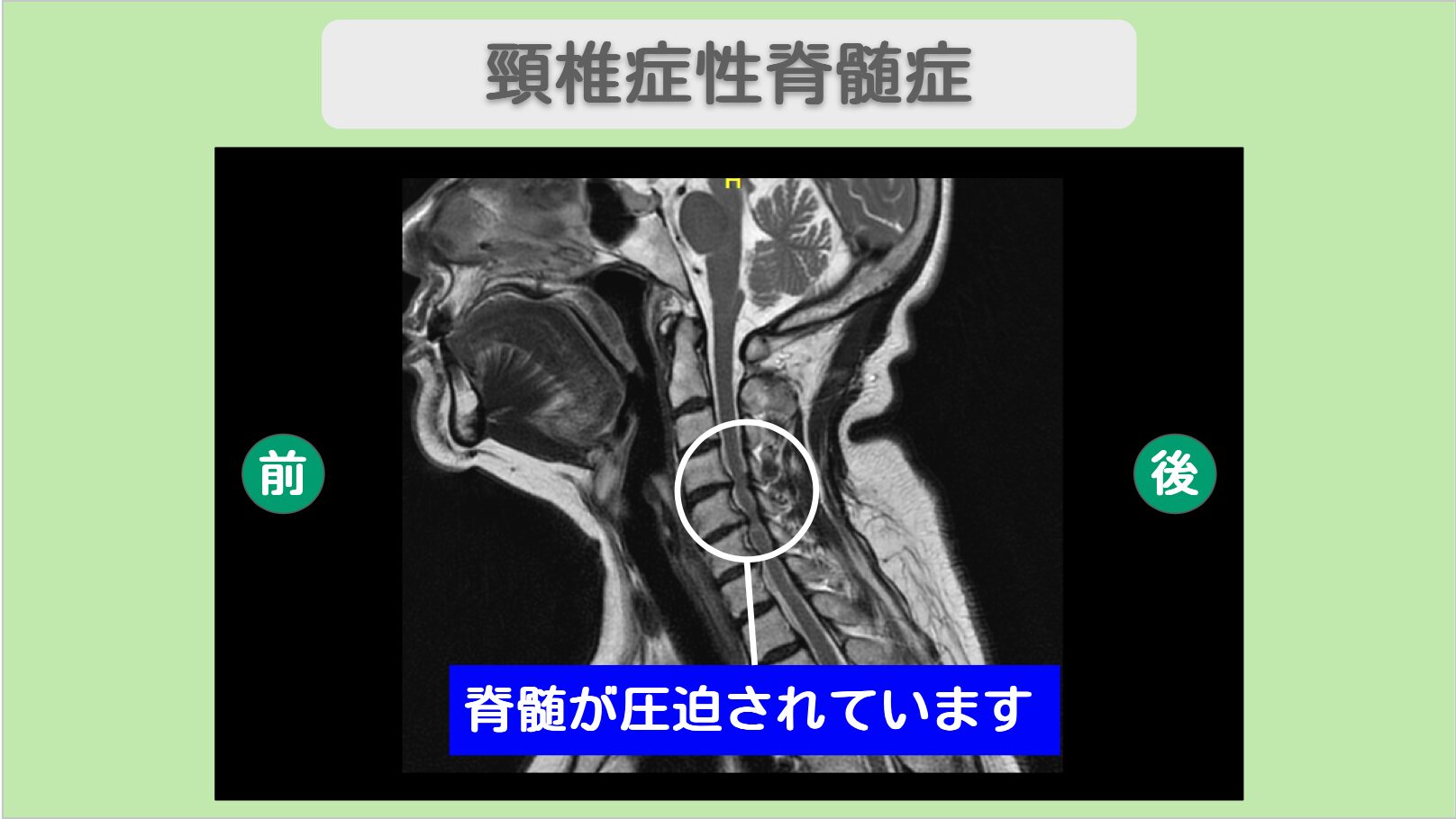 脊椎疾患への新たな光明：手術前に考えたい幹細胞治療の可能性