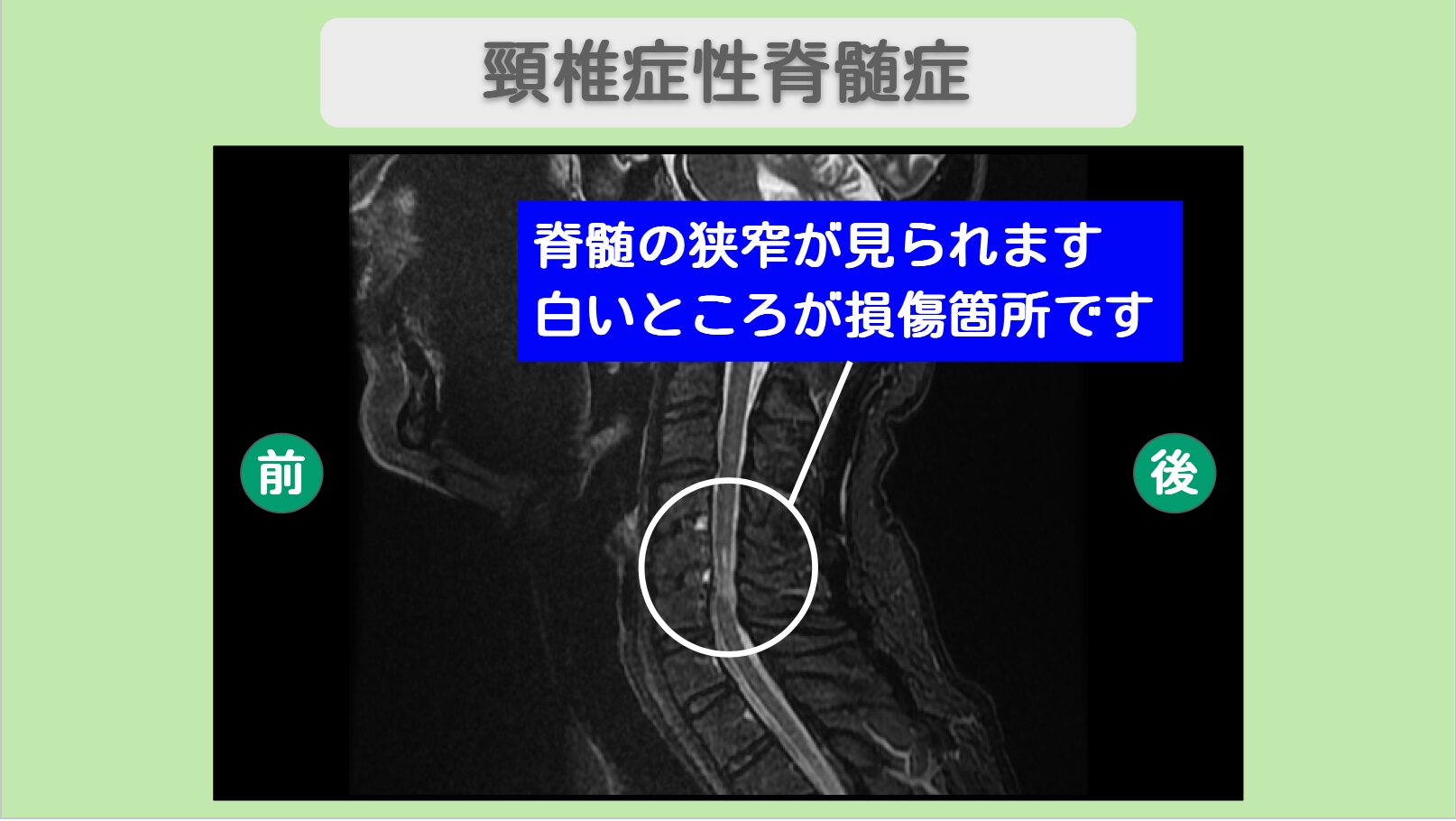 頚椎症性脊髄症 幹細胞治療