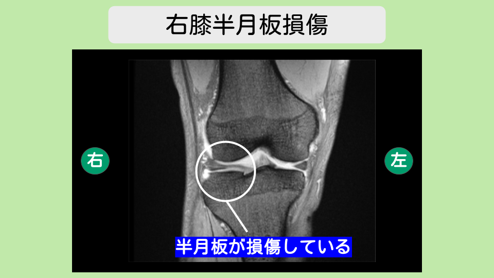 両膝半月板損傷 幹細胞治療