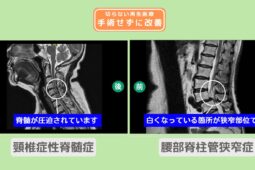 頚椎症性脊髄症、腰部脊柱管狭窄症