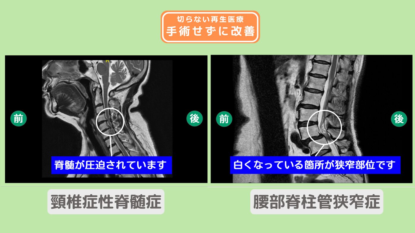 頚椎症性脊髄症、腰部脊柱管狭窄症