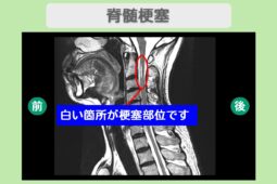 脊髄梗塞　幹細胞治療