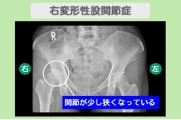 右変形性股関節症 幹細胞治療
