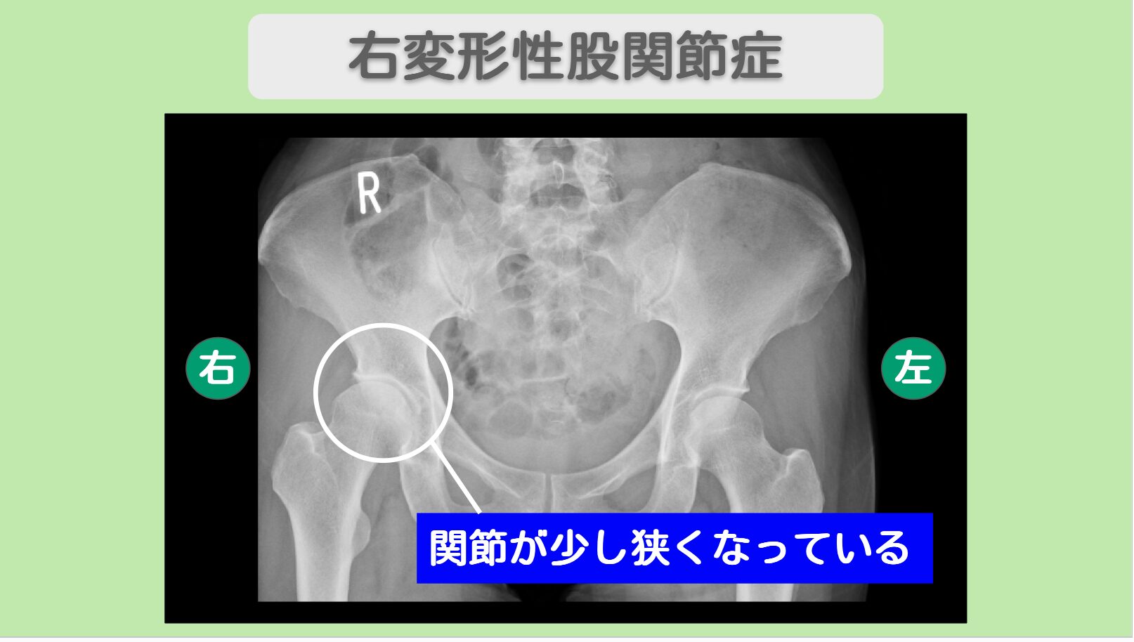 右変形性股関節症 幹細胞治療
