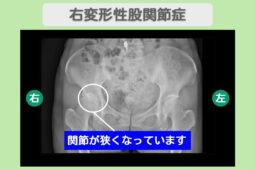 右変形性股関節症（臼蓋形成不全）　幹細胞治療