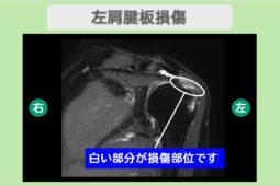 左肩腱板損傷 幹細胞治療