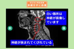 頚椎椎間板ヘルニア　手術なしで回復