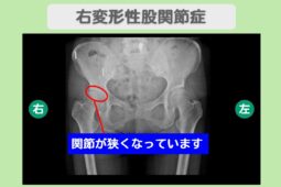 変形性股関節症 分化誘導幹細胞治療