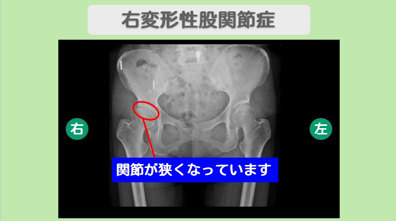 変形性股関節症 分化誘導幹細胞治療