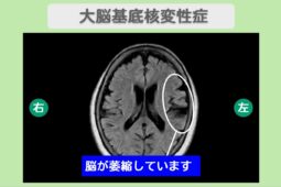 大脳基底核変性症　60代女性
