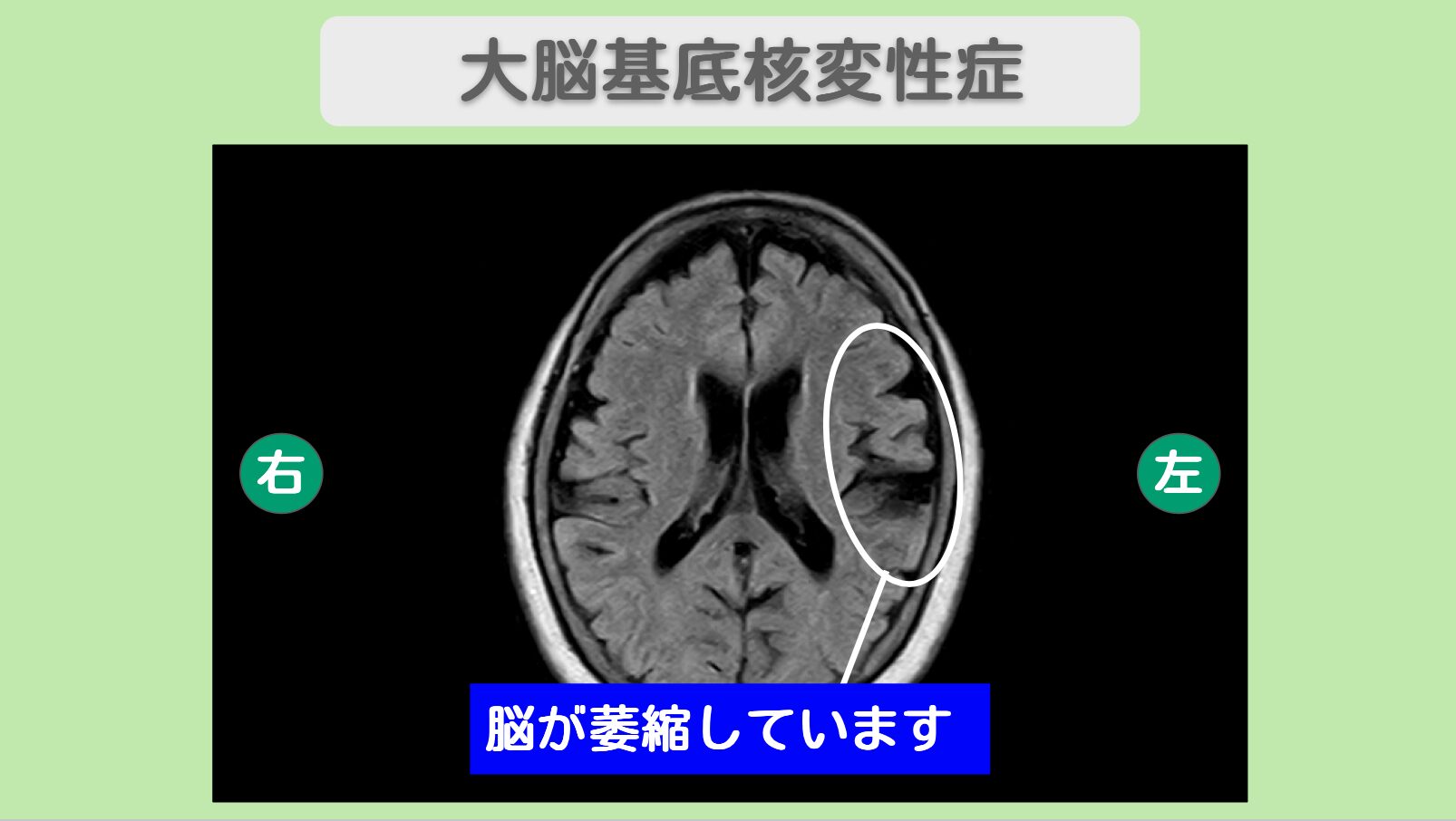 大脳基底核変性症 60代女性